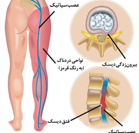متخصص دیسک کمر